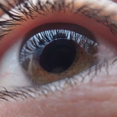 ¿Tienes glaucoma?... 7 de cada 10 lo desconocen