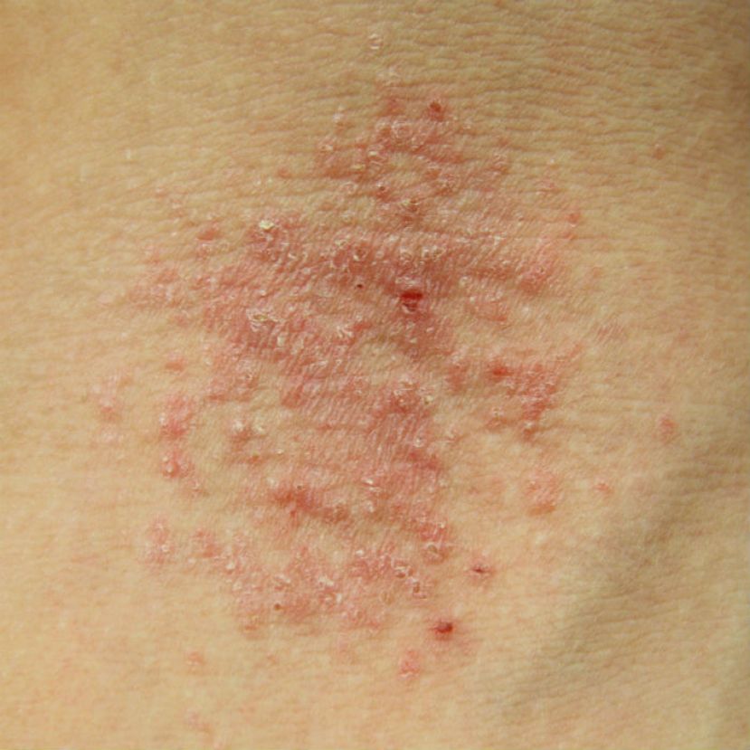 Pfizer va por tratamiento de eczema