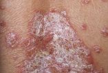 Síndrome metabólico como una comorbilidad de psoriasis