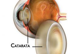 Cataratas, la primera causa de ceguera en México