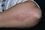 Síndrome metabólico como una comorbilidad de psoriasis