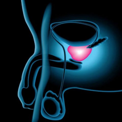 ¿Cáncer de próstata? ya hay un manual para tratarlo