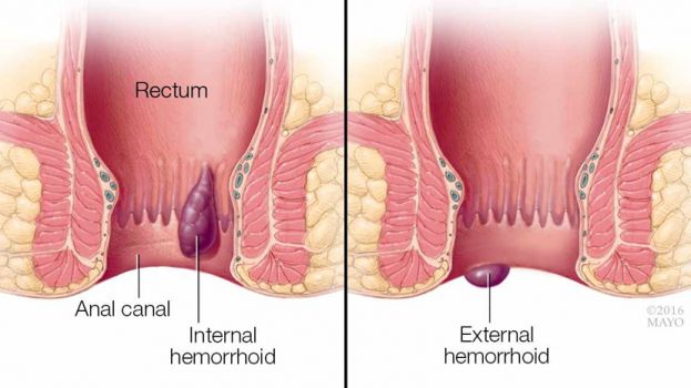 Cómo prevenir y tratar las hemorroides