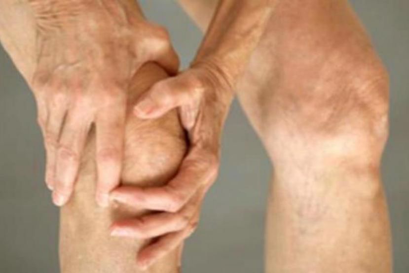 Osteoartritis, qué hacer y cómo enfrentarla