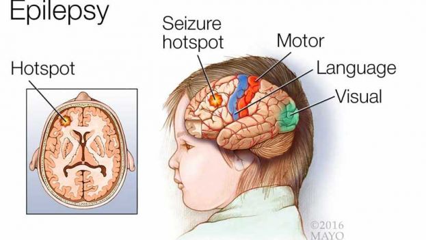 Presentar una convulsión no significa automáticamente que eres epiléptico