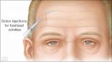 Mitos y realidades sobre el uso del botox para las arrugas